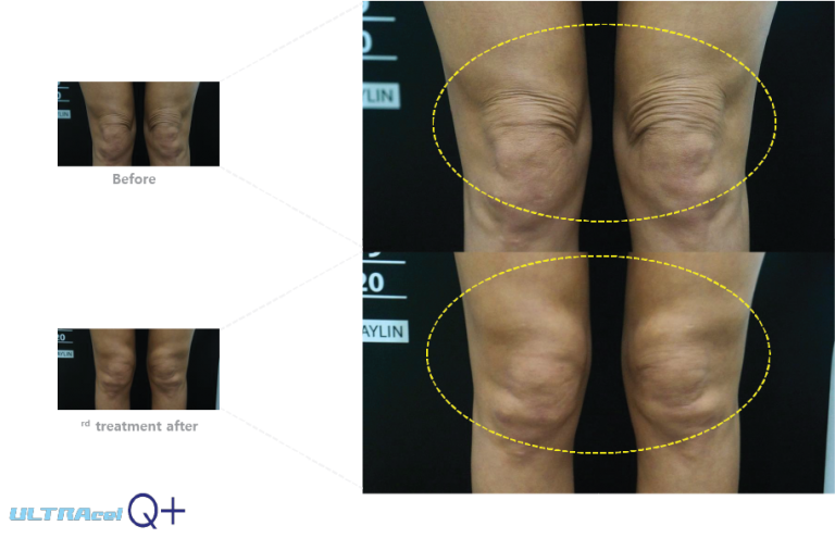 جوانسازی پوست Knee
